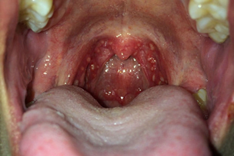 化脓性扁桃体炎扁桃体化脓图 化脓性扁桃体炎扁桃体化脓图
