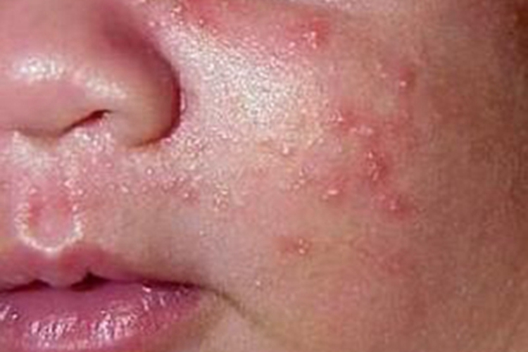 痤疮面部有小脓包图