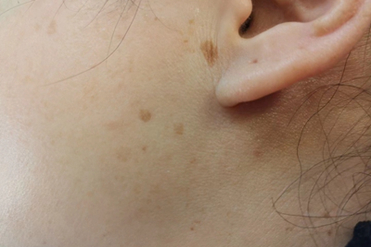 脂溢性角化病耳前斑图