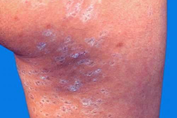 毛囊角化病有坑图