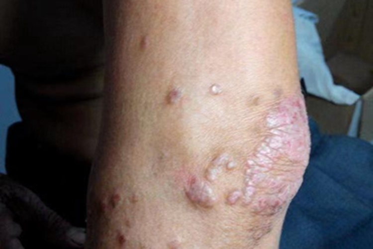 神经性皮炎肘部小红疙瘩图