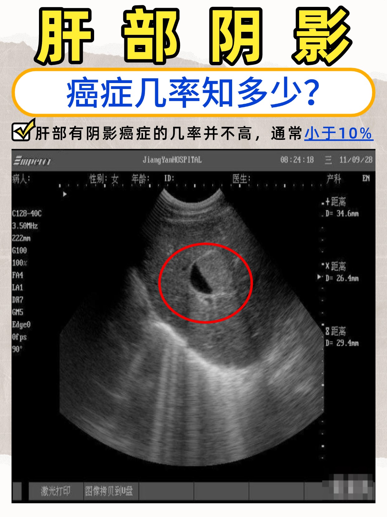 肝部阴影：癌症几率知多少？
