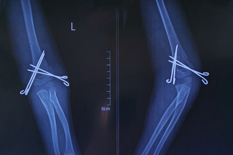 伸直型肱骨髁上骨折图