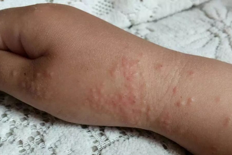 小孩沙土皮炎图 小孩沙土皮炎图