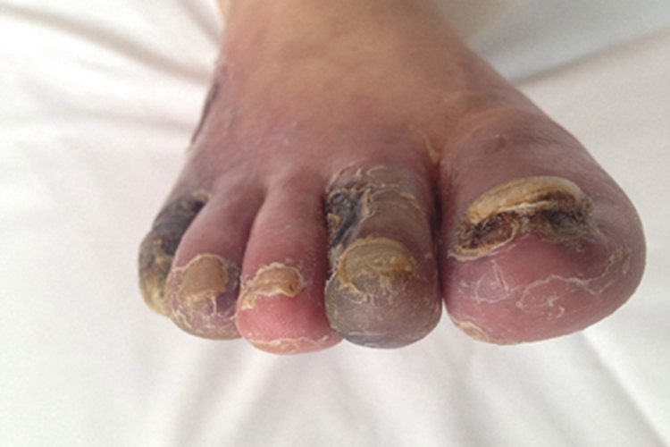 干性坏疽脚趾脱屑图