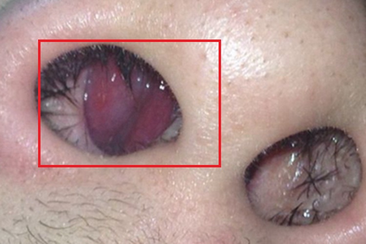 慢性化脓性鼻窦炎鼻腔充血图