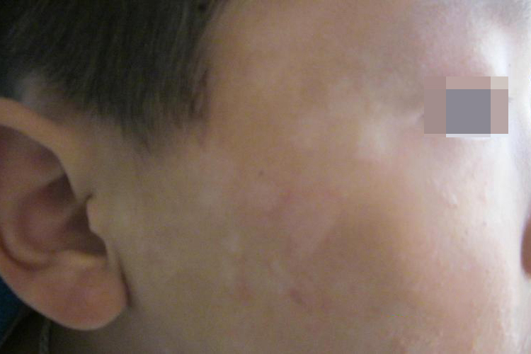 眼角单纯糠疹图