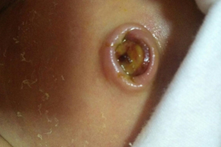 脐炎肚脐周围红肿有黄色脓液图