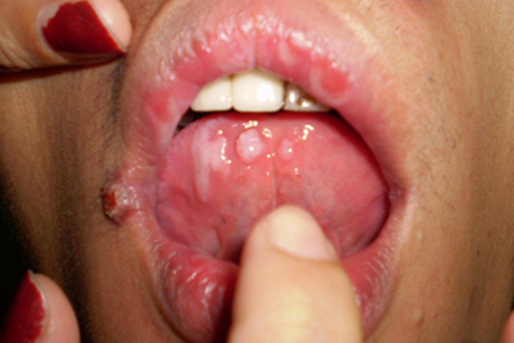 过敏性接触性口炎舌尖症状图 过敏性接触性口炎舌尖症状图