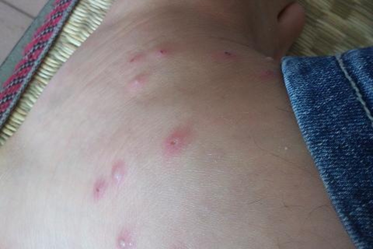 蚂蚁咬后起包图