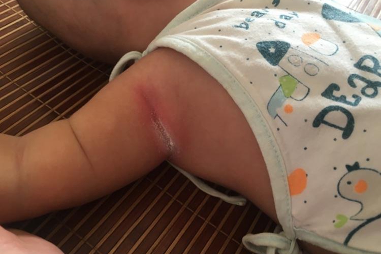 汗液浸渍腋下肉裂开泛红图