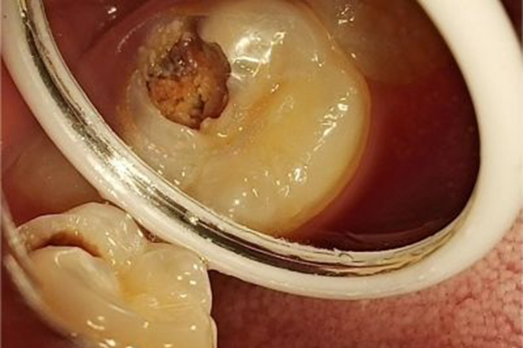 深龋牙齿咬合面见黑洞图 深龋牙齿咬合面见黑洞图