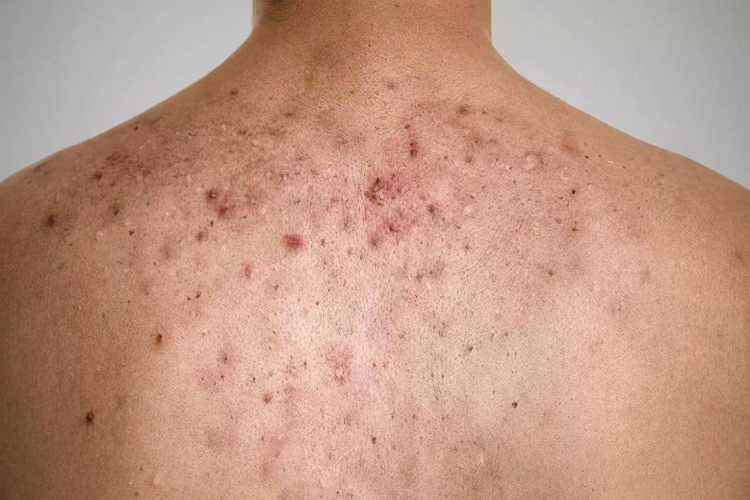 背部痤疮图 背部痤疮图