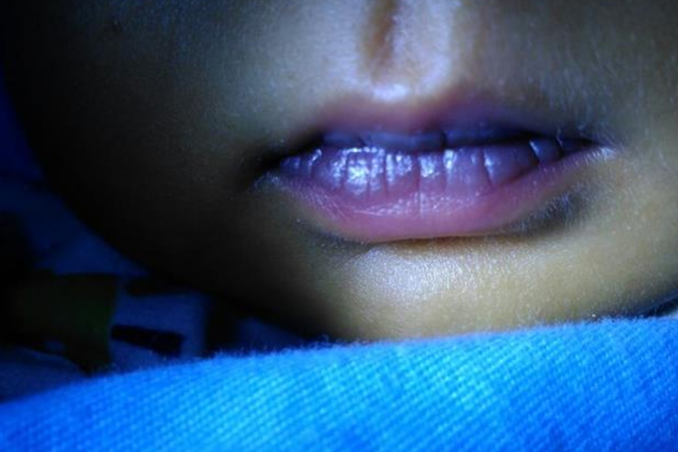 肺炎口周发绀图