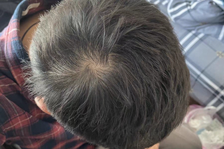 雄激素性脱发头发稀疏干燥图 雄激素性脱发头发稀疏干燥图