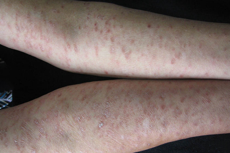 慢性苔藓样糠疹胳膊脱屑图