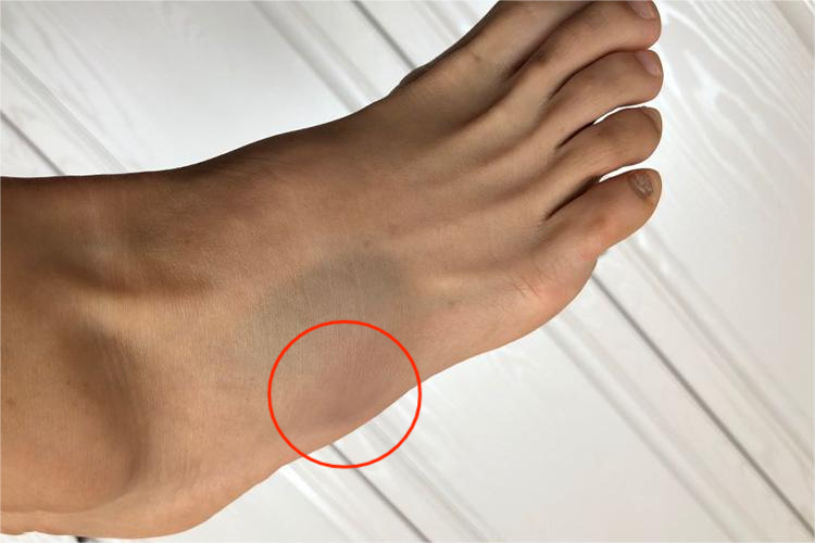 第5跖骨基底骨折肿胀图