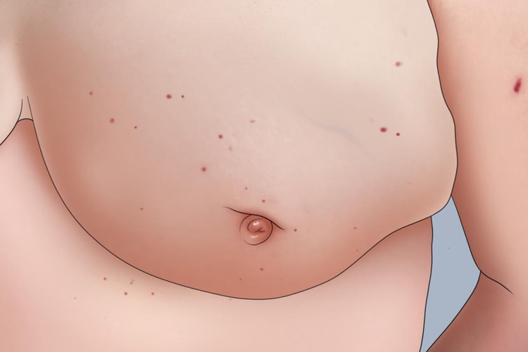 乳腺癌肿块图 乳腺癌肿块图