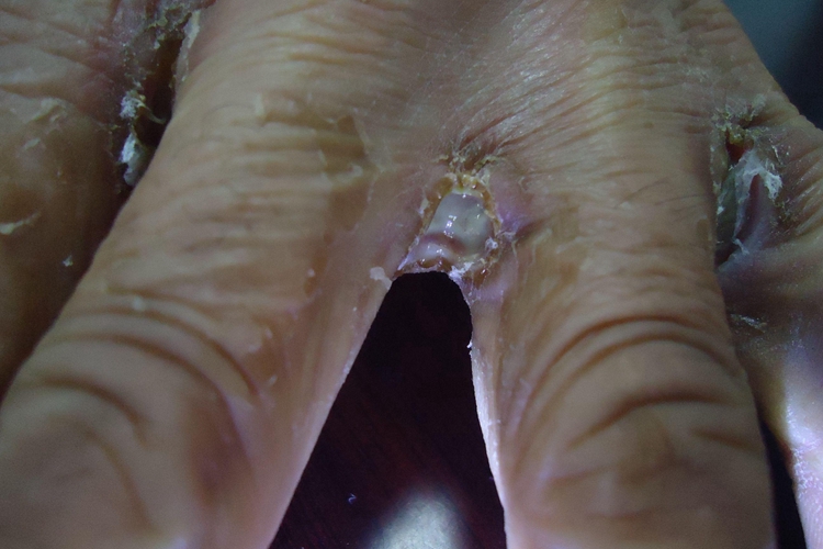 皮肤感染糜烂图 皮肤感染糜烂图