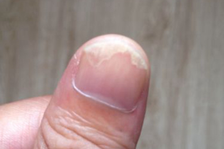 脱甲病手指甲分离图