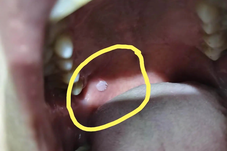 口腔白色角化病图