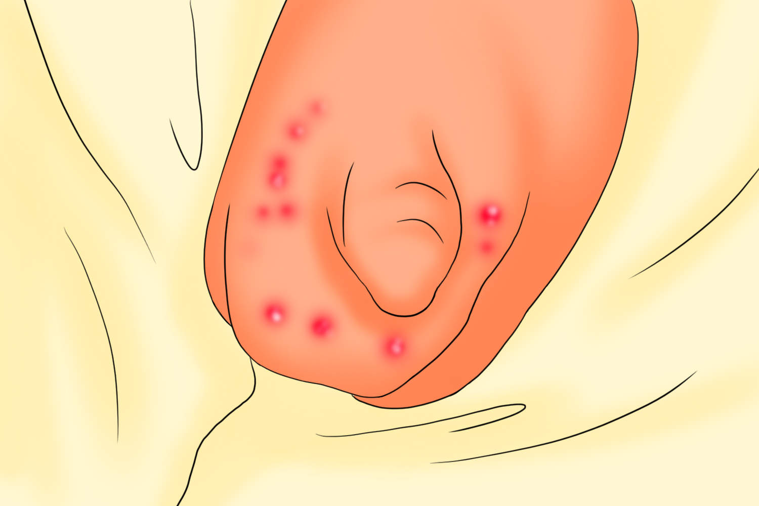 男性早期复发性生殖器疱疹图