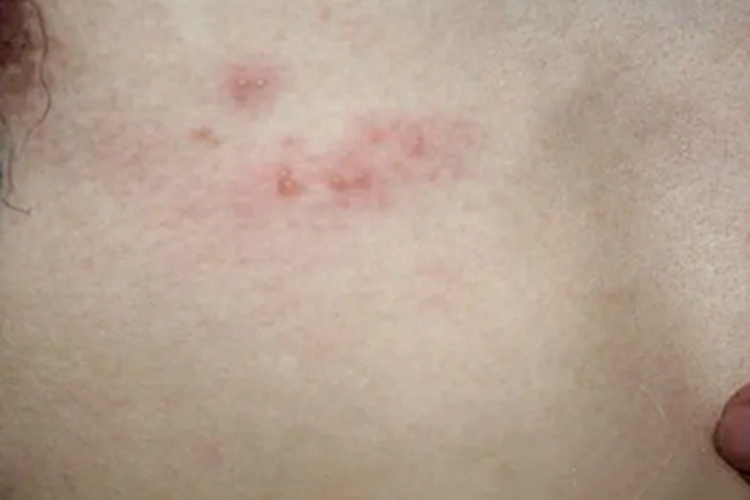 带状疱疹初期图