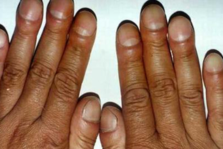 杵状指手指尖膨大类似鼓槌图