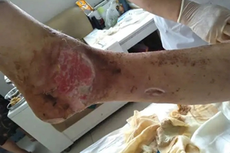 溃疡型坏疽性脓皮病脚踝溃疡图