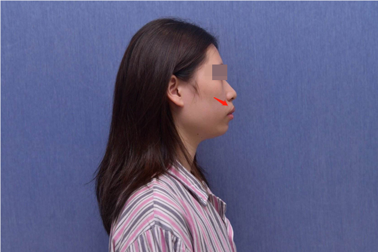 上颌前突导致严重嘴凸图 上颌前突导致严重嘴凸图