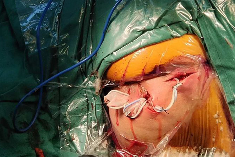 肛门脓肿手术挂橡皮筋图