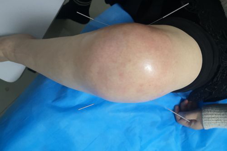 类风湿性关节炎膝关节肿胀图 类风湿性关节炎膝关节肿胀图