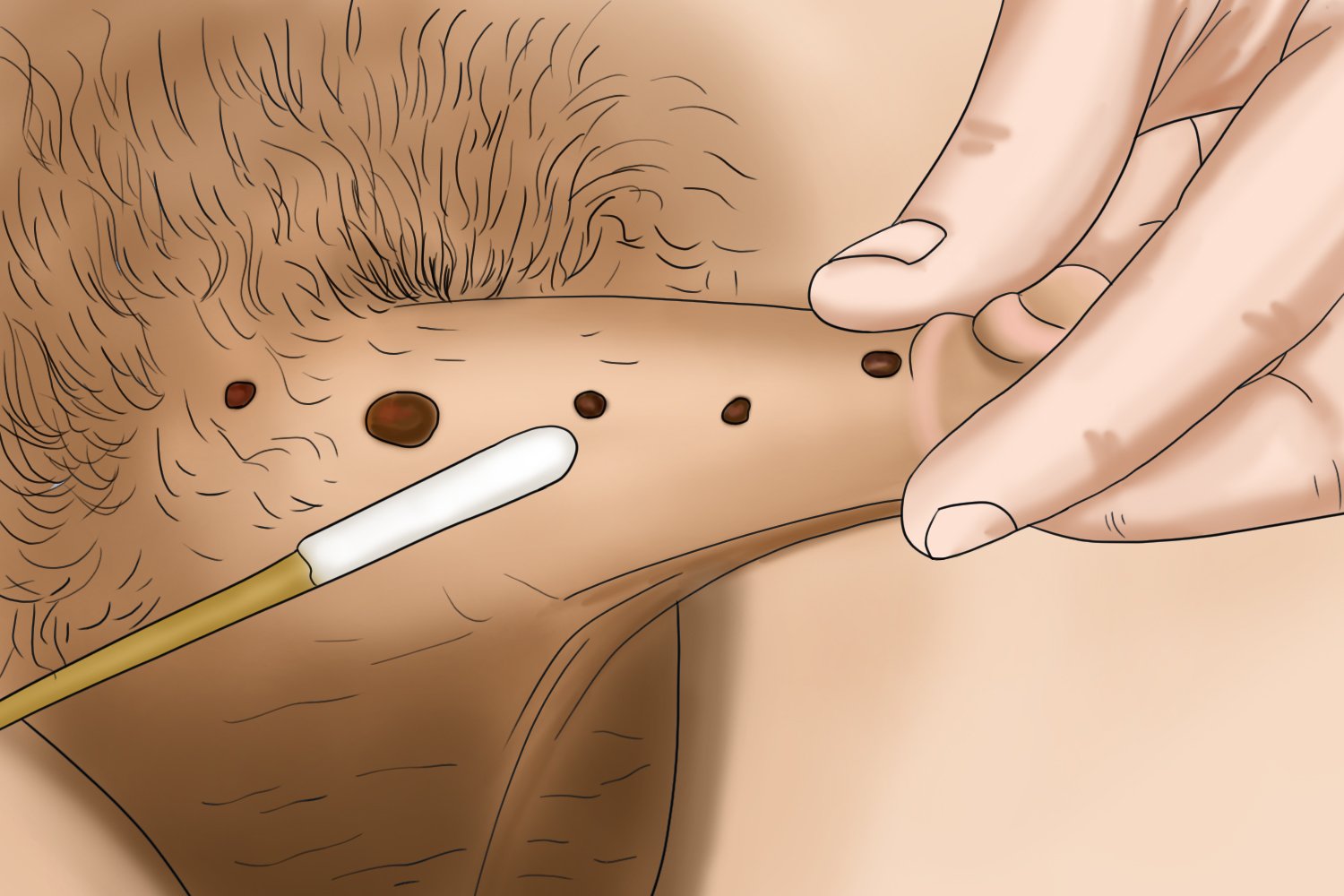 包皮软纤维瘤图