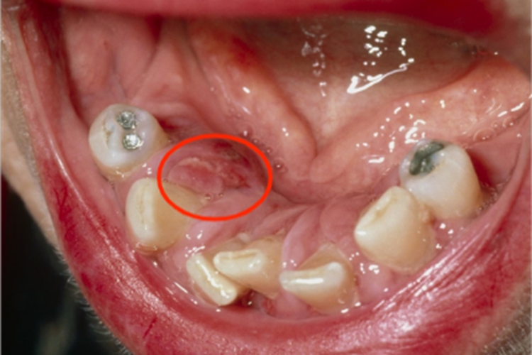 急性坏死性龈口炎牙龈溃疡图