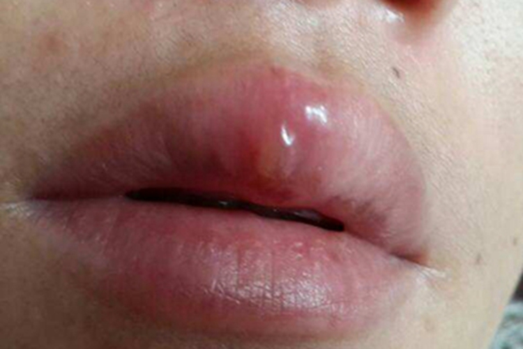 口唇疱疹嘴巴上有一个水疱图 口唇疱疹嘴巴上有一个水疱图
