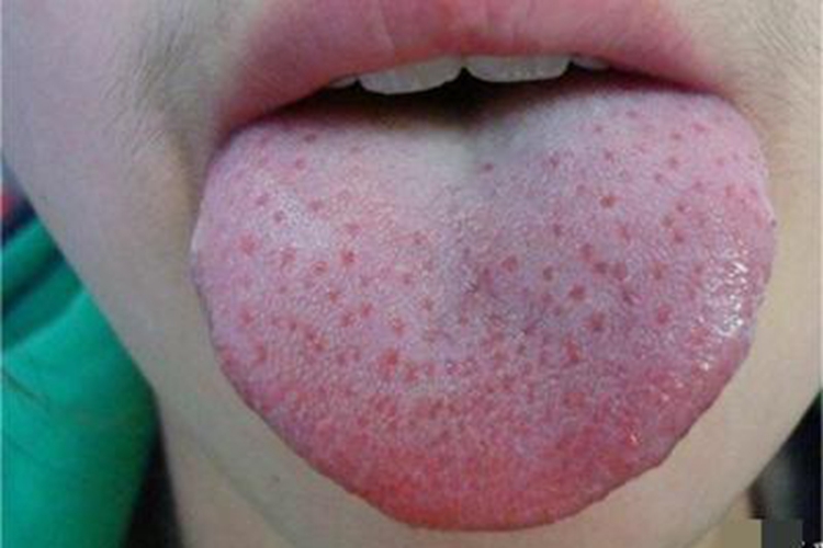 猩红热舌头小红疙瘩图