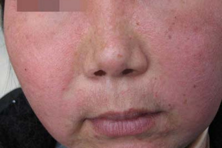 斑块型多形性日光疹面部有红斑图