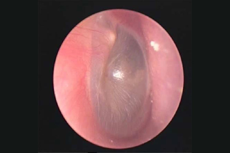 耳朵里白色鼓泡图