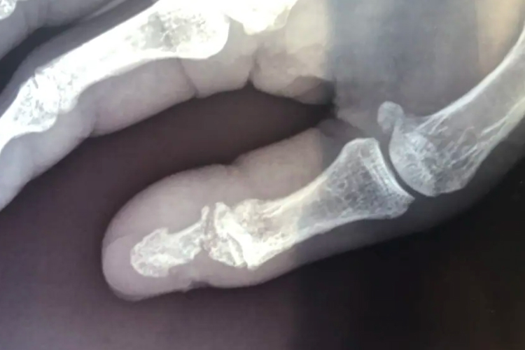 拳击手骨折影像图 拳击手骨折影像图