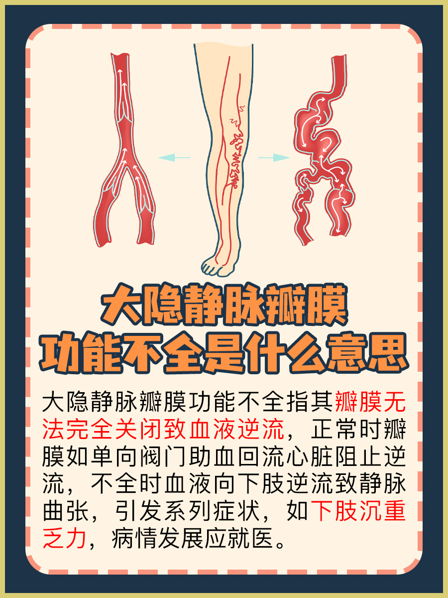 一文解析：大隐静脉瓣膜功能不全是什么意思