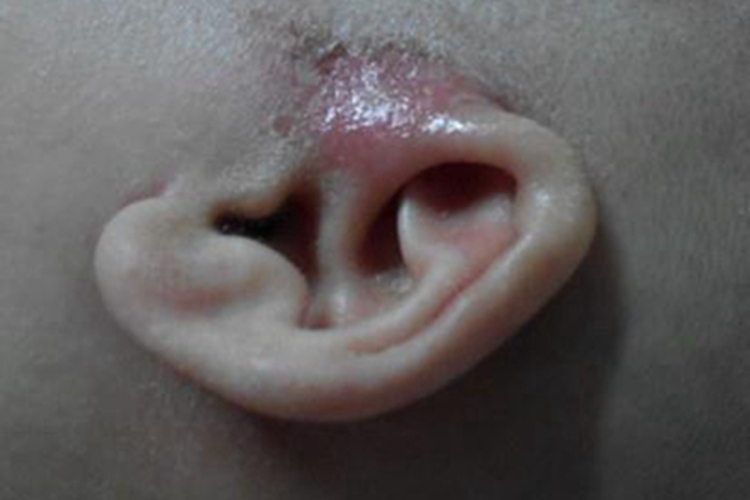 外耳湿疹耳朵发红有点烂图 外耳湿疹耳朵发红有点烂图