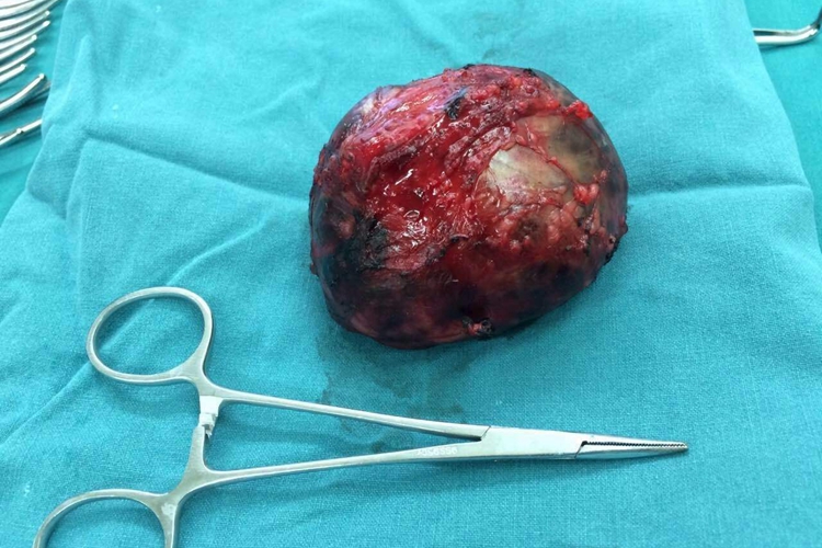 神经母细胞瘤图