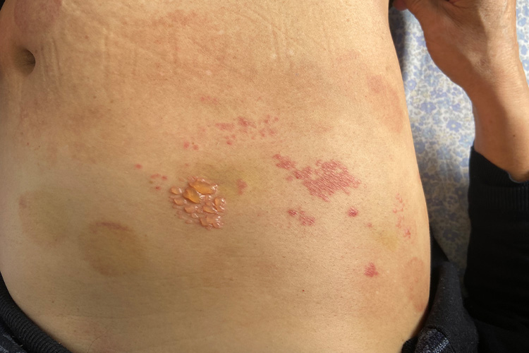 带状疱疹图 带状疱疹图