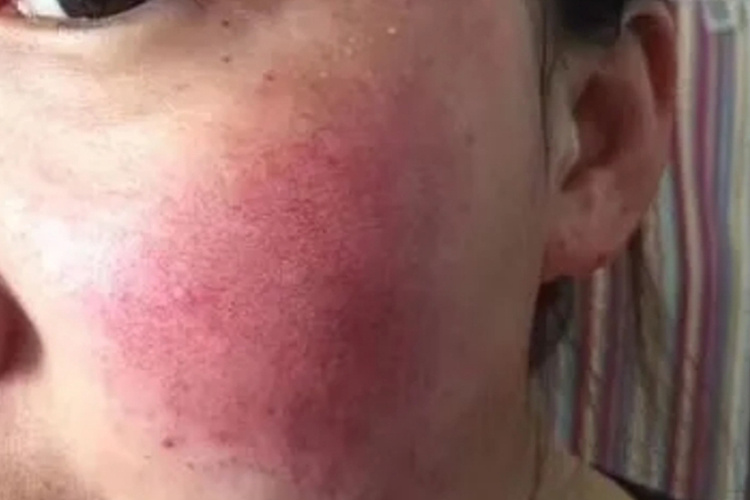 红色斑状红血丝图