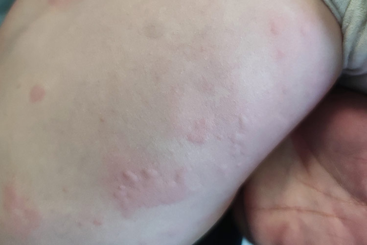 婴儿吃胡萝卜过敏红点荨麻疹图