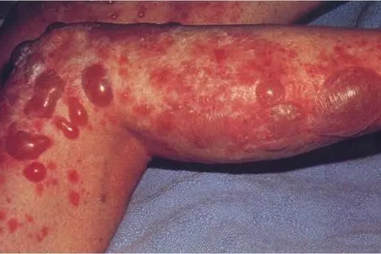 副肿瘤性天疱疮小腿水疱图