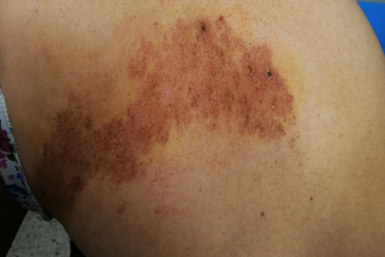 带状疱疹结痂图