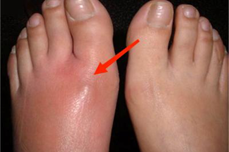 急性期皮肤丝虫病脚部红肿图