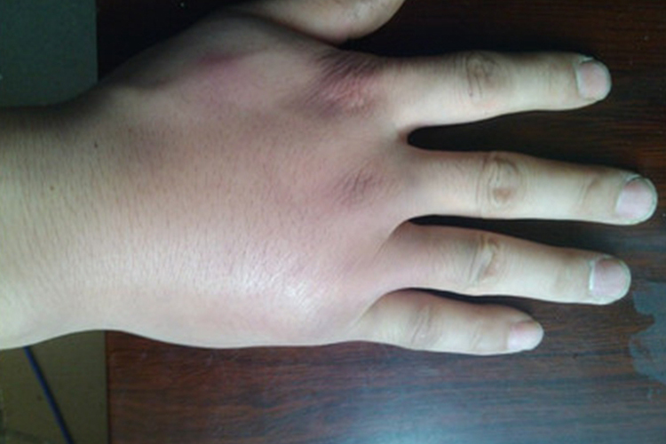 风寒外袭无名肿毒漫肿图