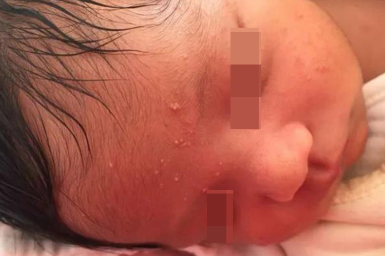 新生儿闭合性粉刺有白尖图